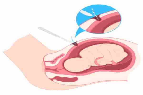 ما هي مميزات وعيوب الولادة القيصرية؟
