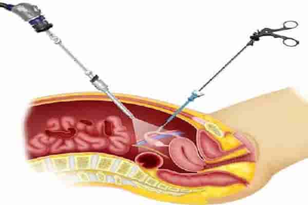 استئصال الرحم