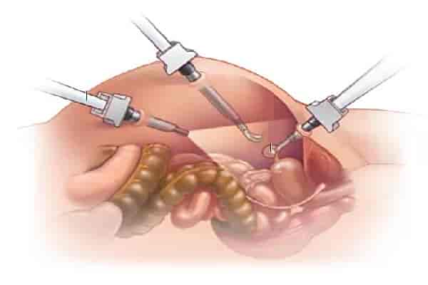 استئصال المبيض