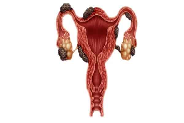 تحليل بطانة الرحم