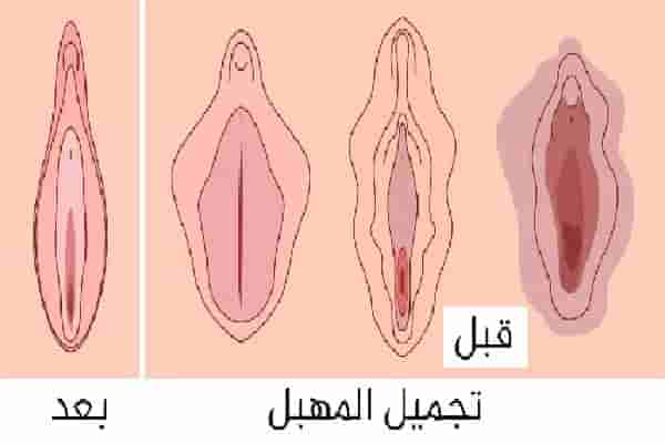 تجميل المهبل